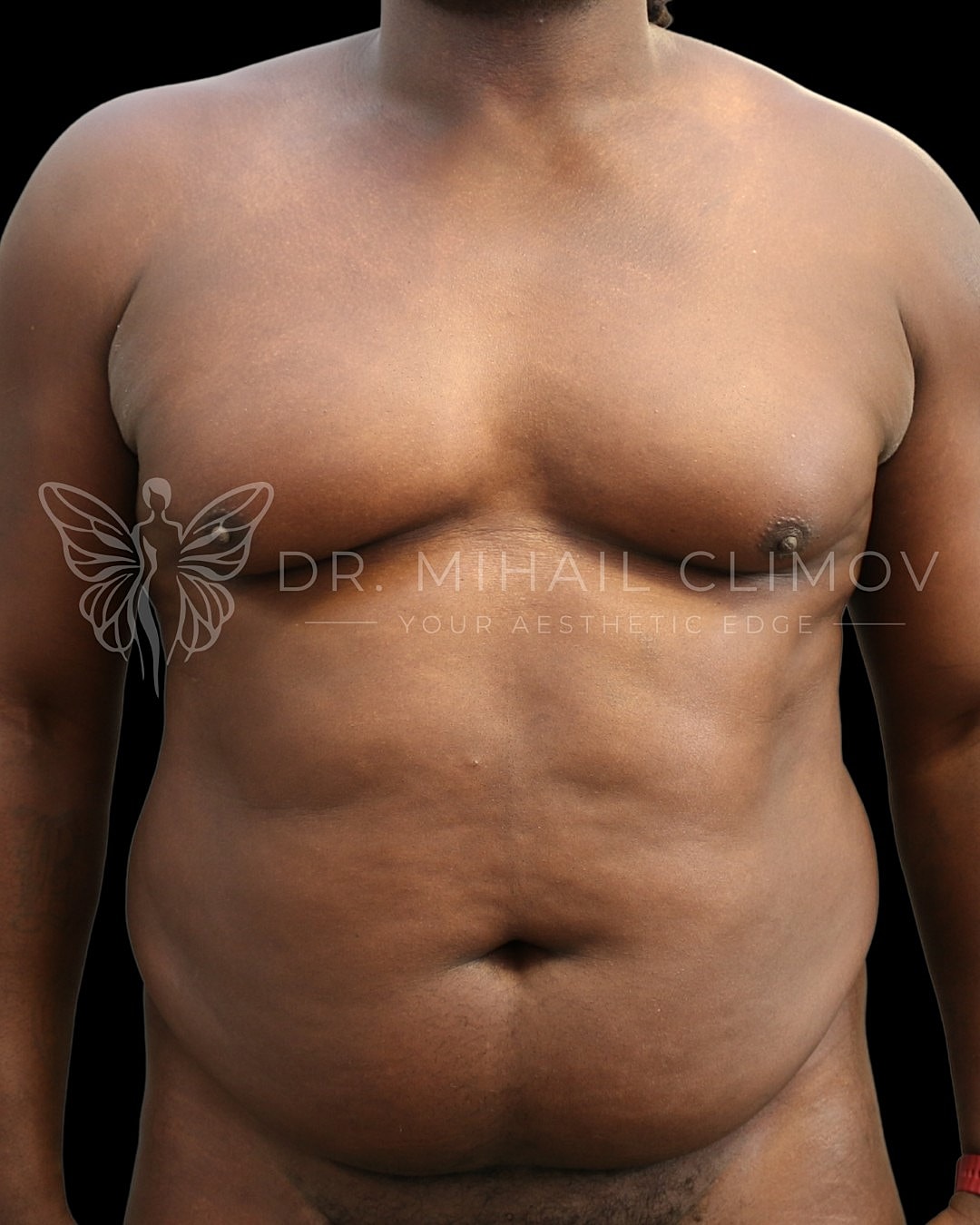 Case_001_before_front__8_.png Before daddy do-over surgery – front view – Dr. Mihail Climov, Aesthetic Plastic Surgeon, Houston, TX