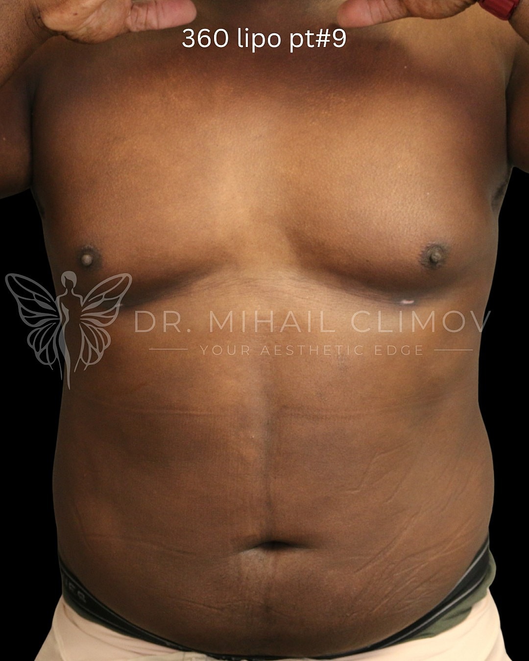 Case_001_after_front__3_.png After daddy do-over results – front view – Dr. Mihail Climov, Aesthetic Plastic Surgeon, Houston, TX