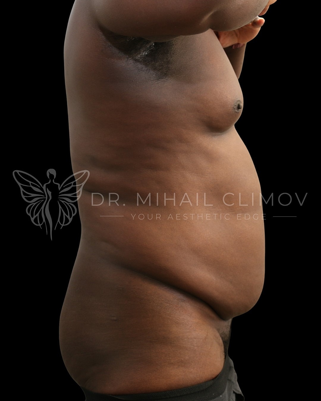 Case_001_before_front__6_.png Before daddy do-over surgery – side profile view – Dr. Mihail Climov, Aesthetic Plastic Surgeon, Houston, TX