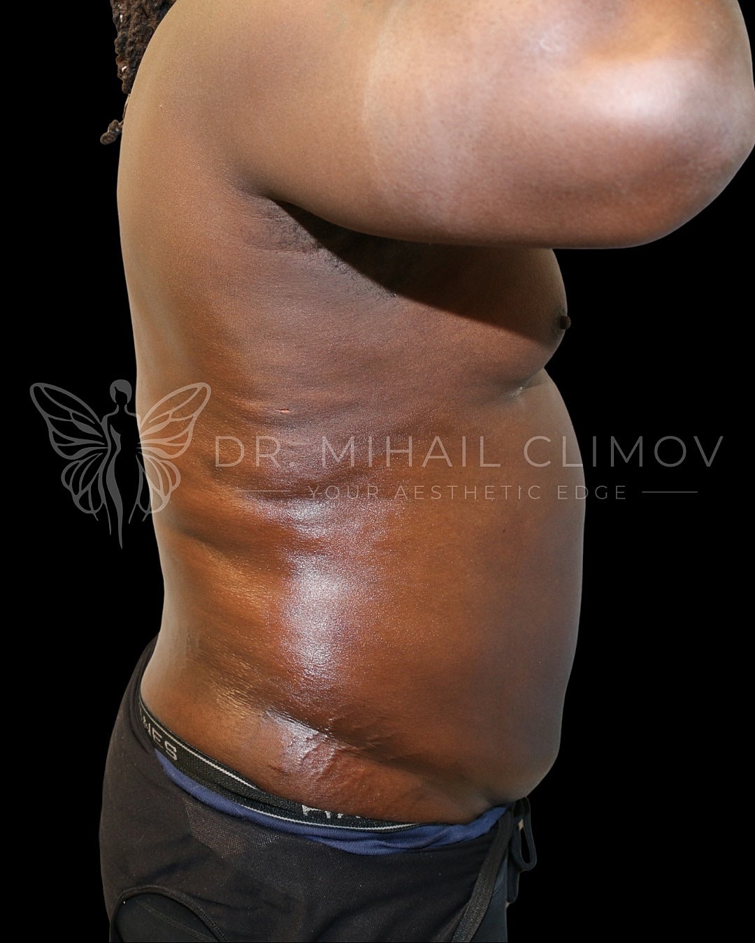 Case_001_after_front__5_.png After daddy do-over results – side profile view – Dr. Mihail Climov, Aesthetic Plastic Surgeon, Houston, TX