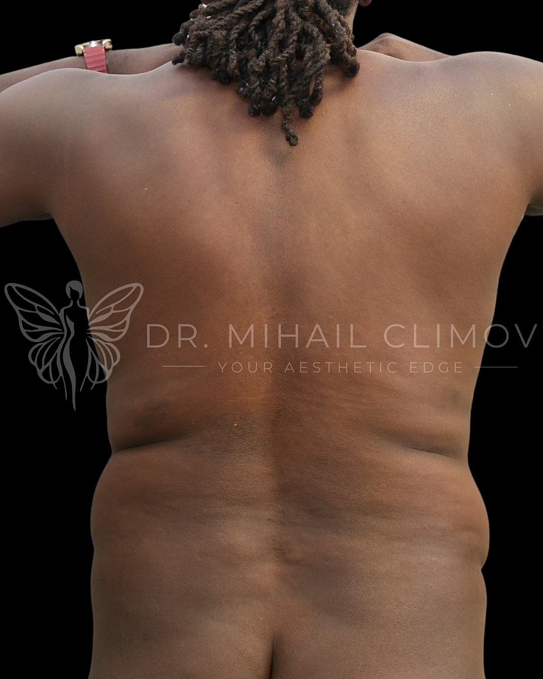 Case_001_before_front__4_.png Before daddy do-over surgery – back view – Dr. Mihail Climov, Aesthetic Plastic Surgeon, Houston, TX