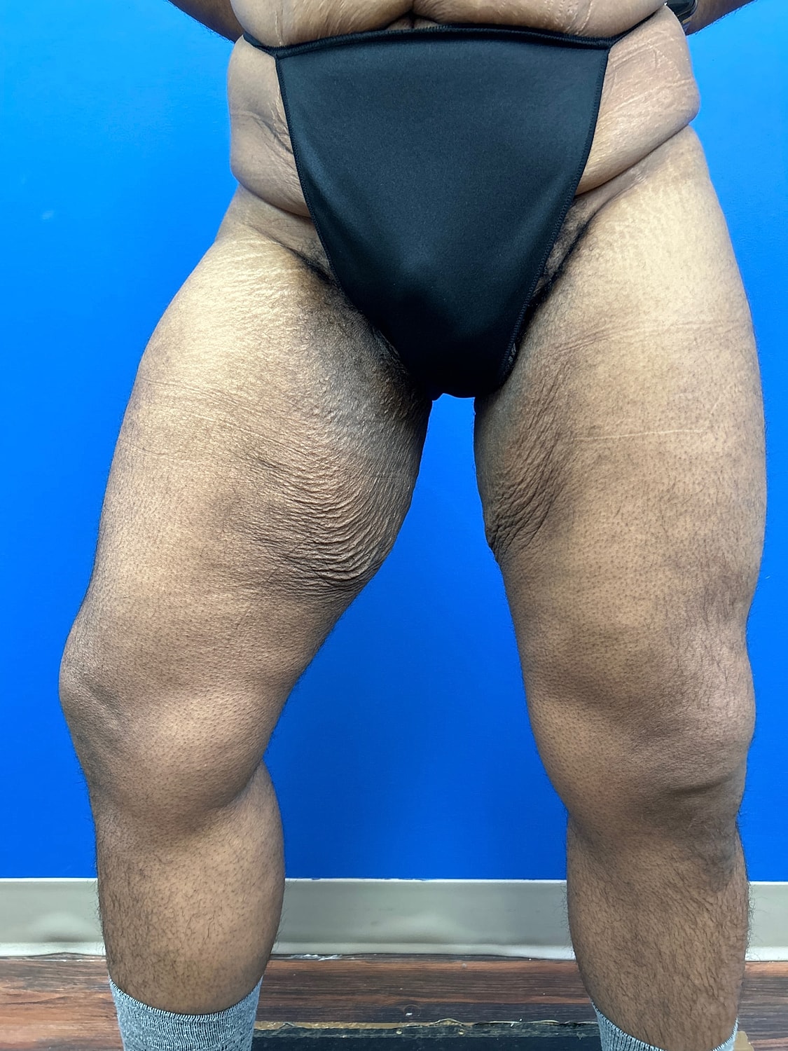 Thigh Lift Before & After
