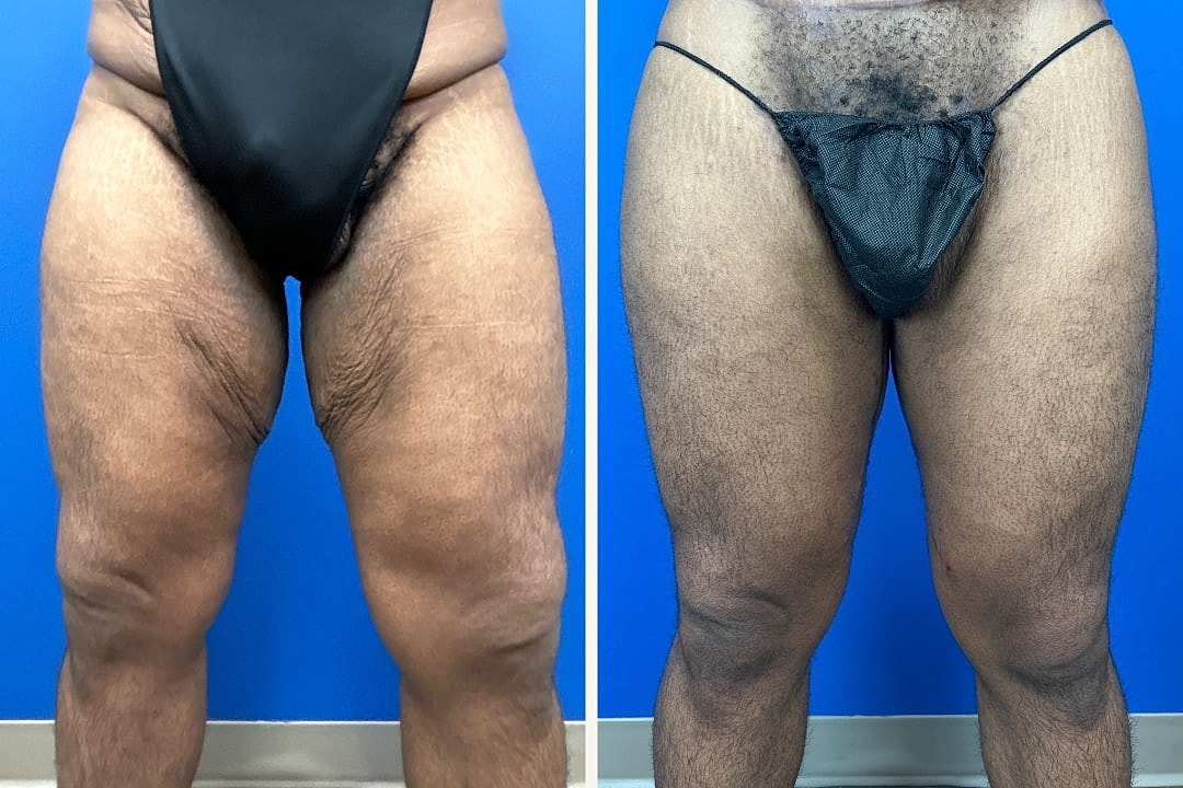 Thigh Lift Before & After