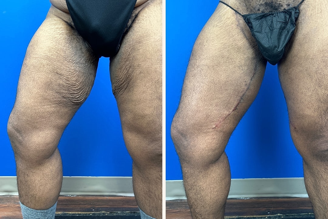Thigh Lift Before & After
