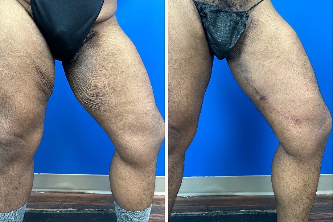 Thigh Lift Before & After