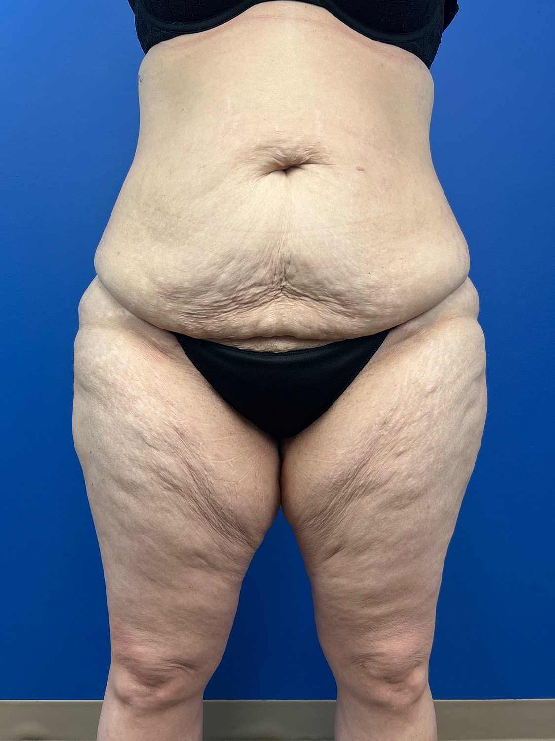 Thigh Lift Before & After