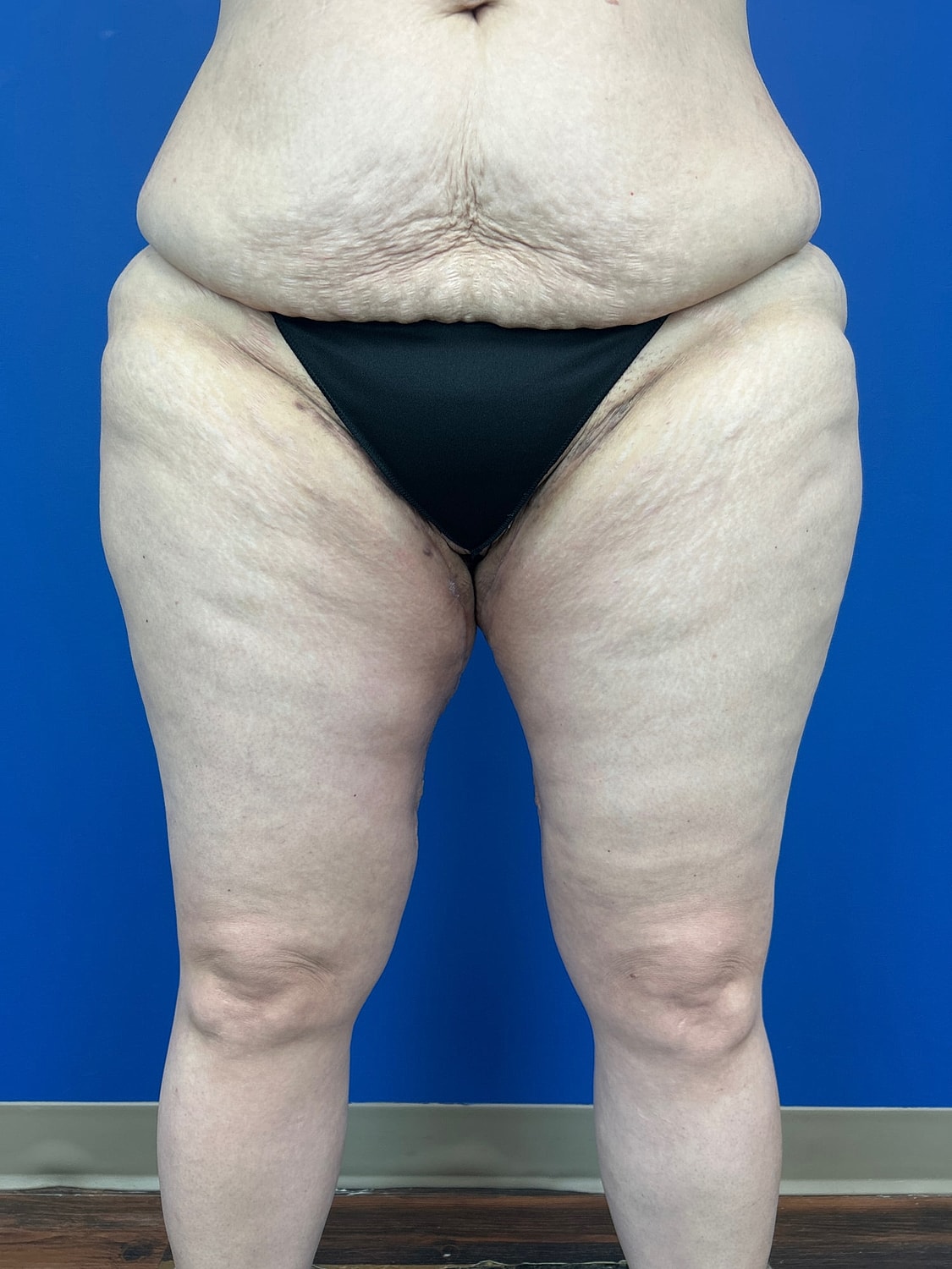 Thigh Lift Before & After