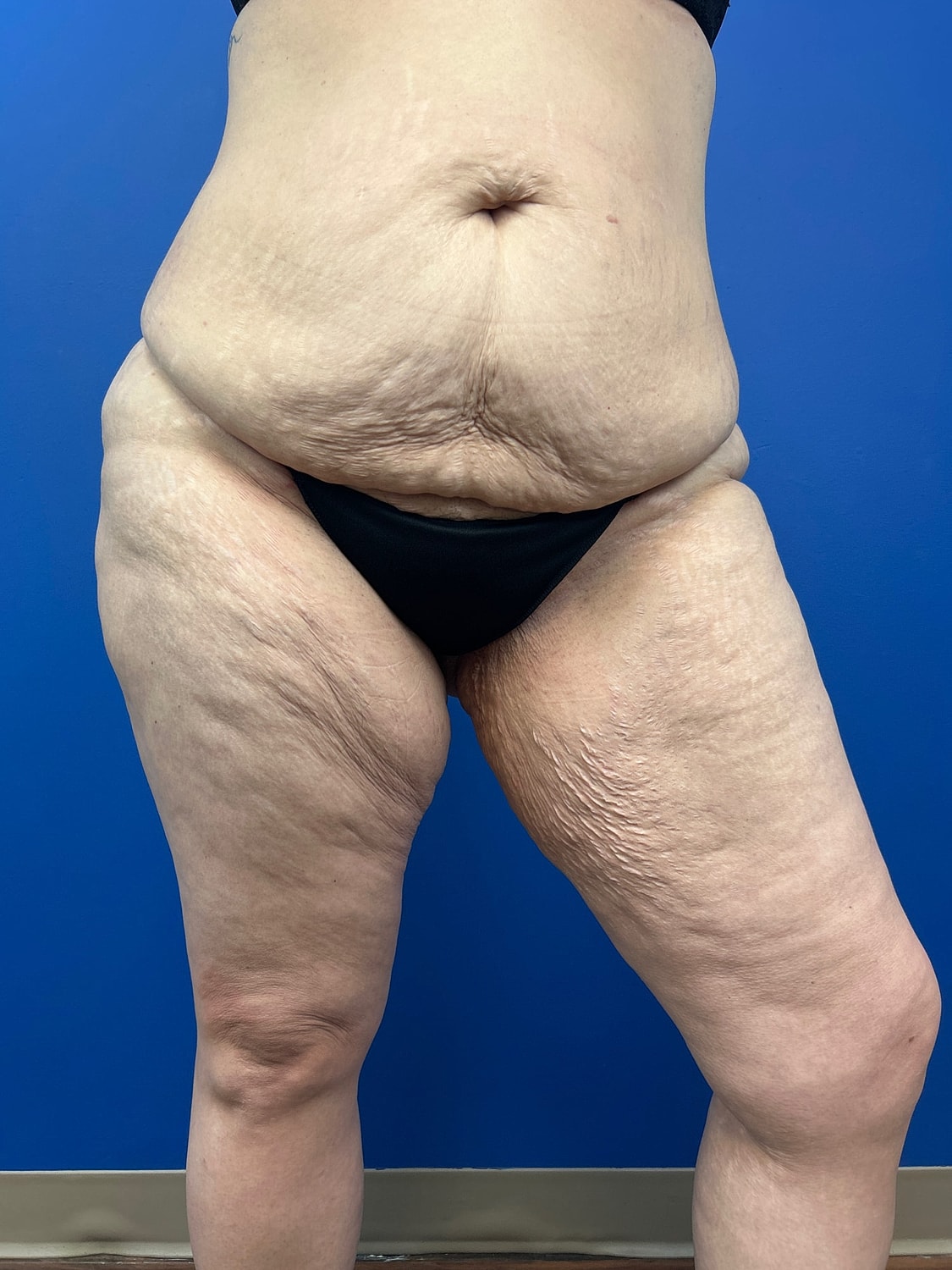 Thigh Lift Before & After