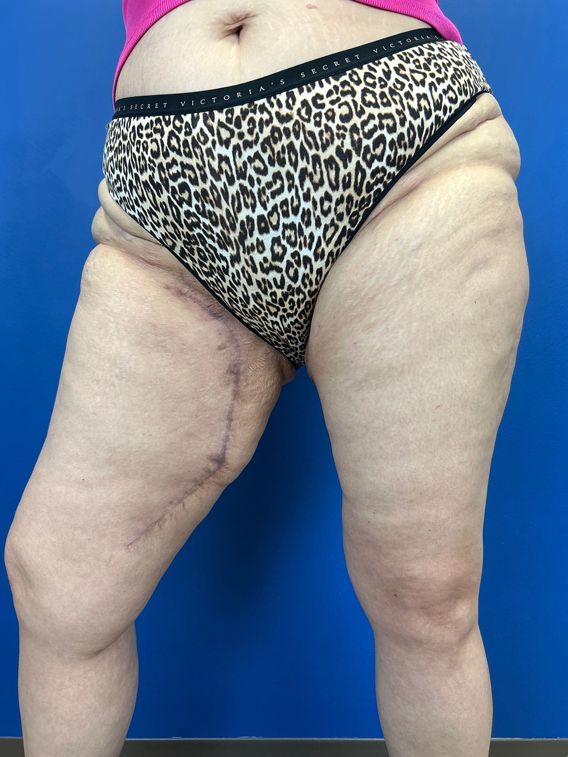 Thigh Lift Before & After