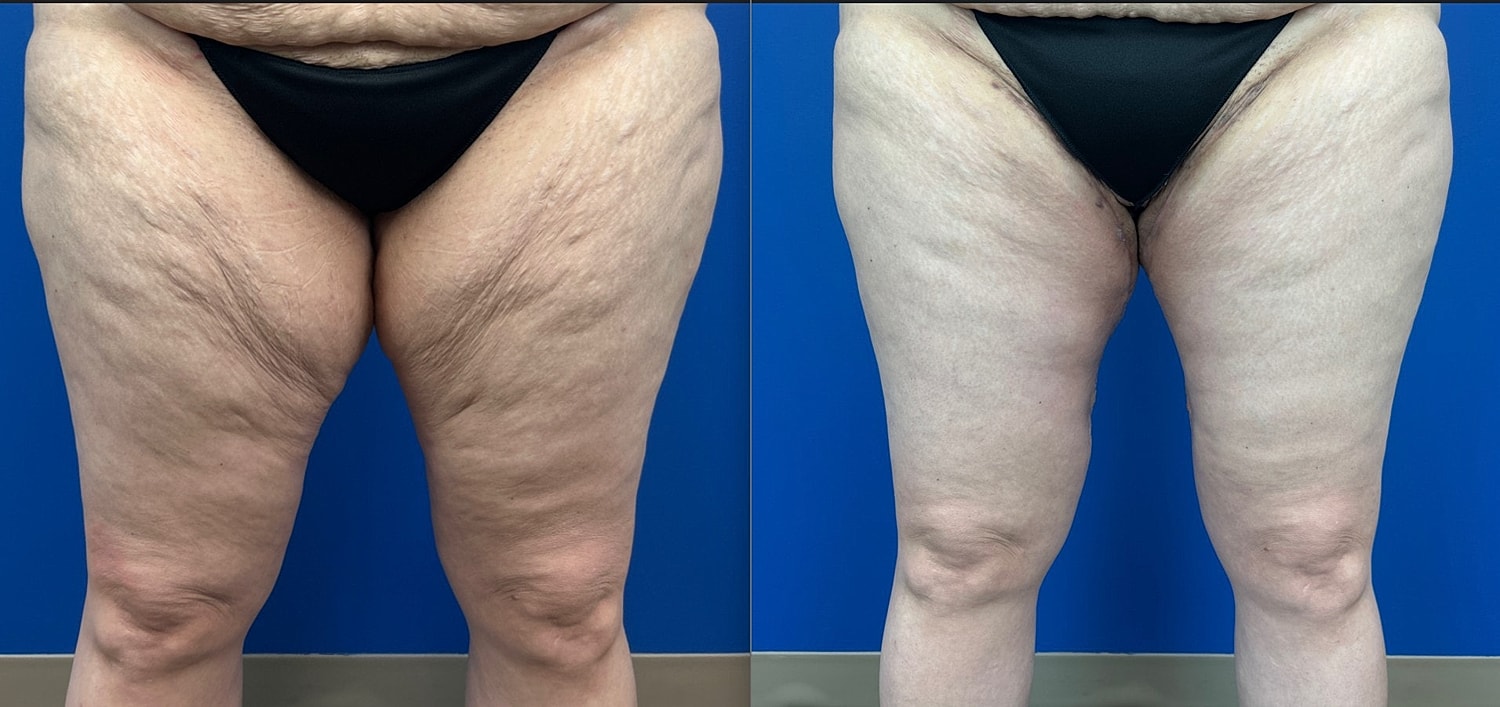 Thigh Lift Before & After