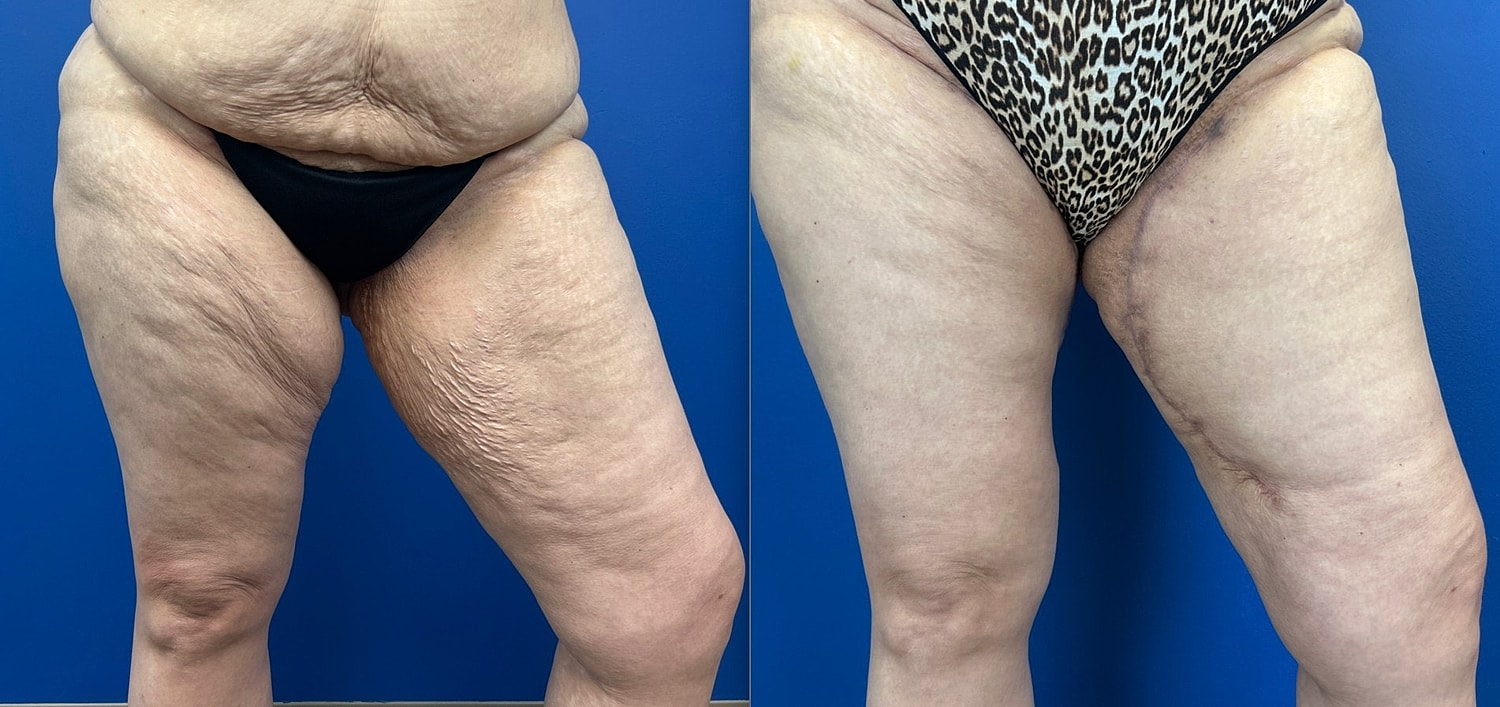 Thigh Lift Before & After