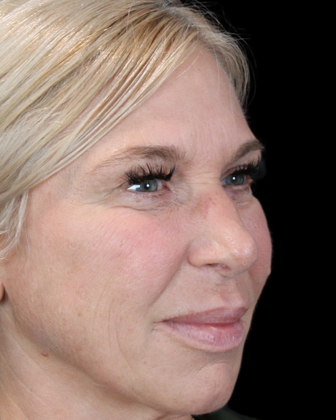 Rhinoplasty Before & After