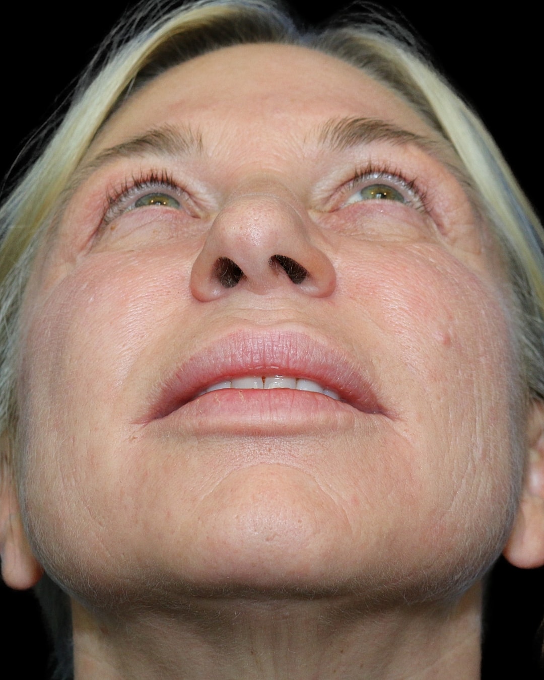 Rhinoplasty Before & After