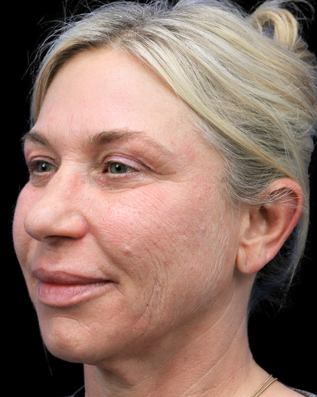 Rhinoplasty Before & After