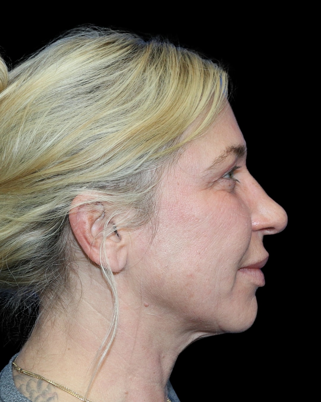 Rhinoplasty Before & After