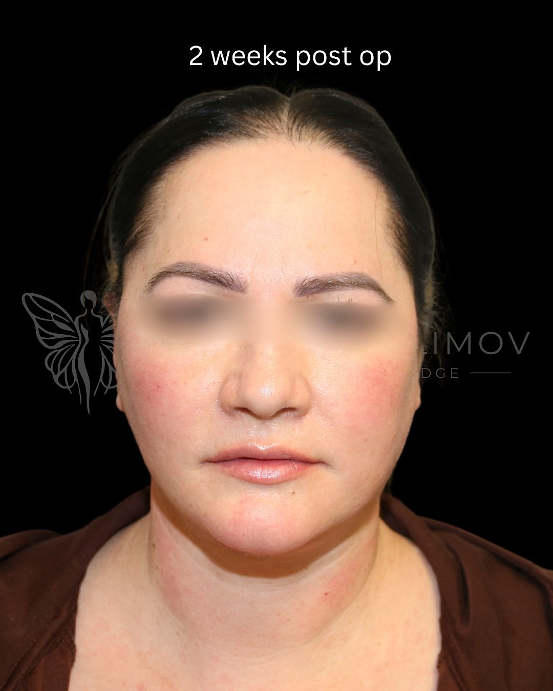 Post-operative facial recovery, two weeks later.