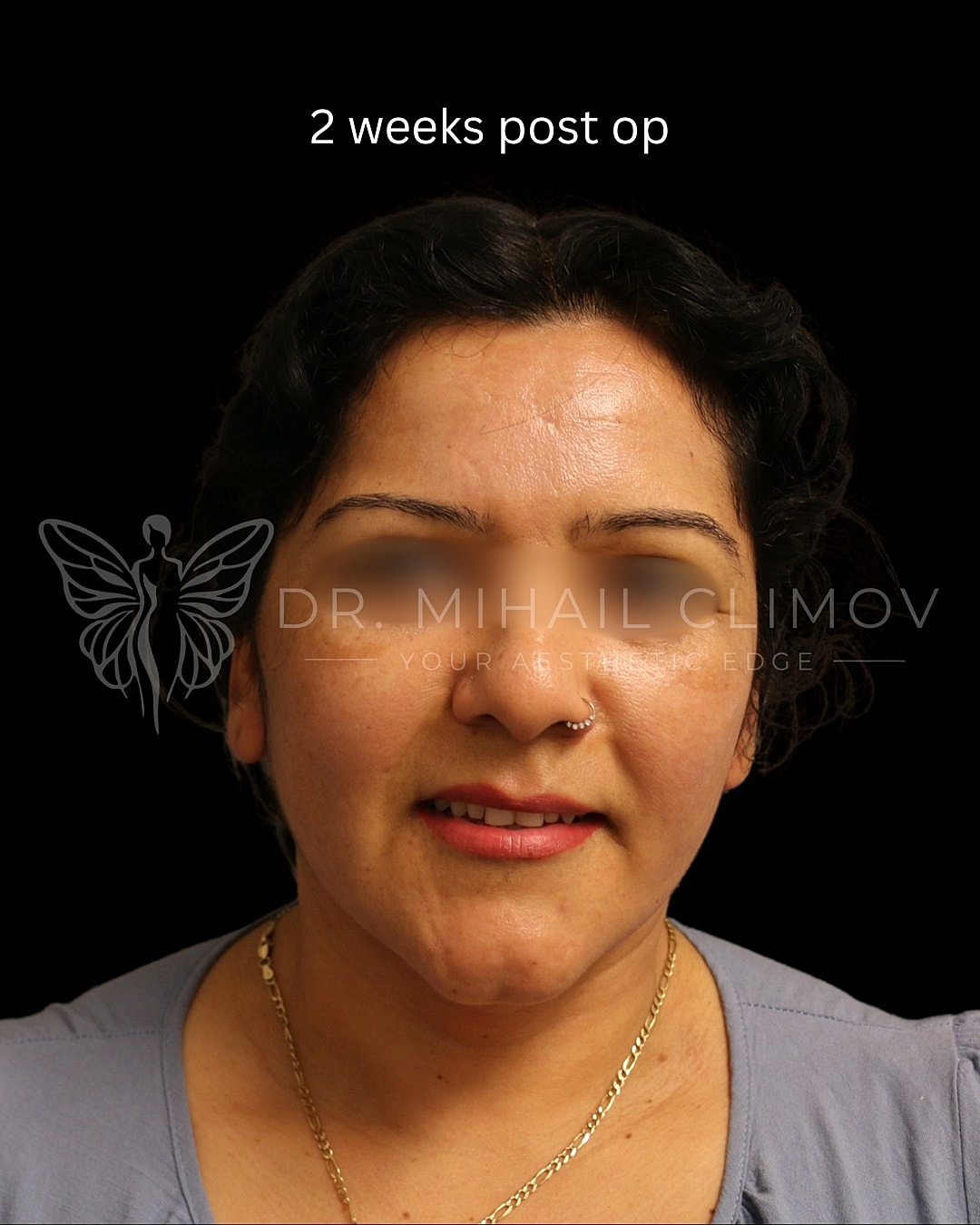 Two weeks post-operative recovery photo.