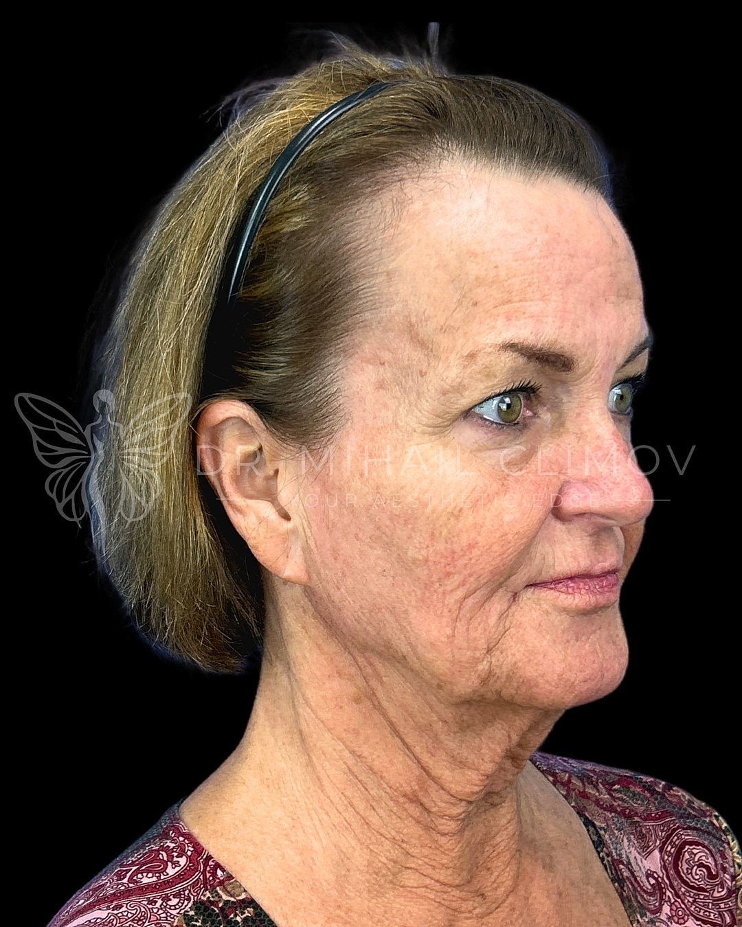 Woman with short hair and headband, profile view.