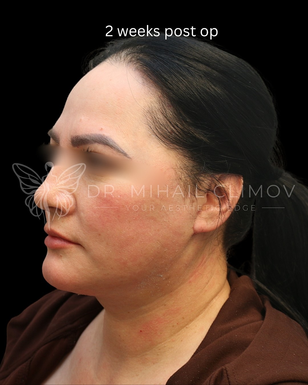 Post-operative recovery at two weeks.