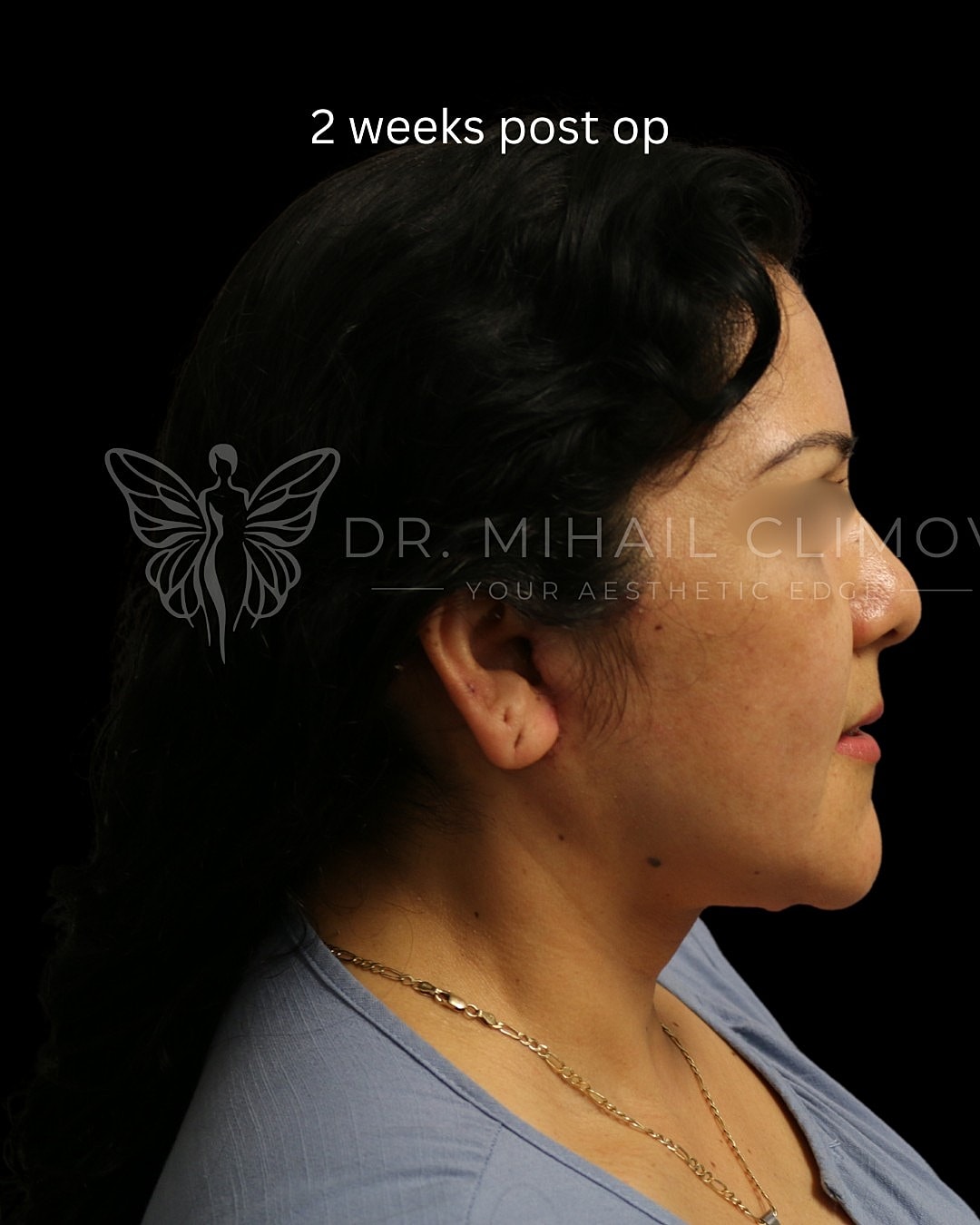 Profile view, two weeks after surgery.