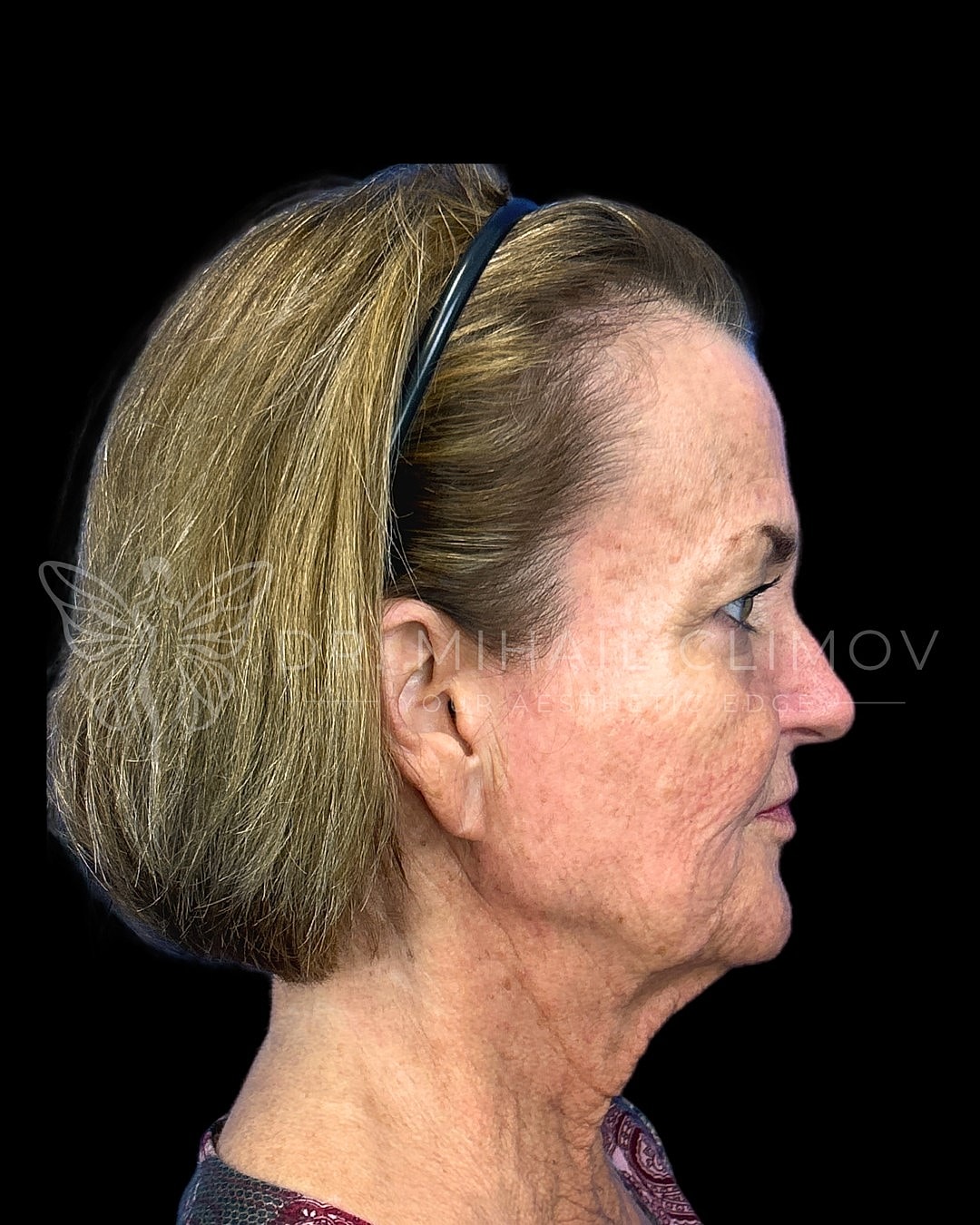 Profile view of a woman with short hair.