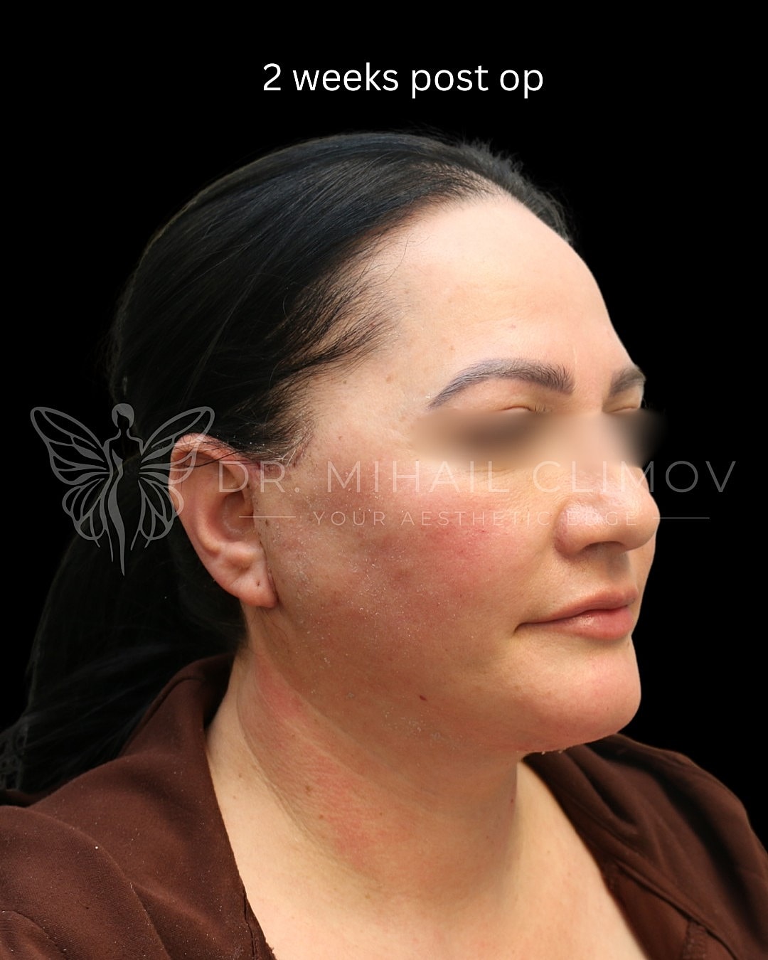 Post-operative recovery, two weeks after procedure.