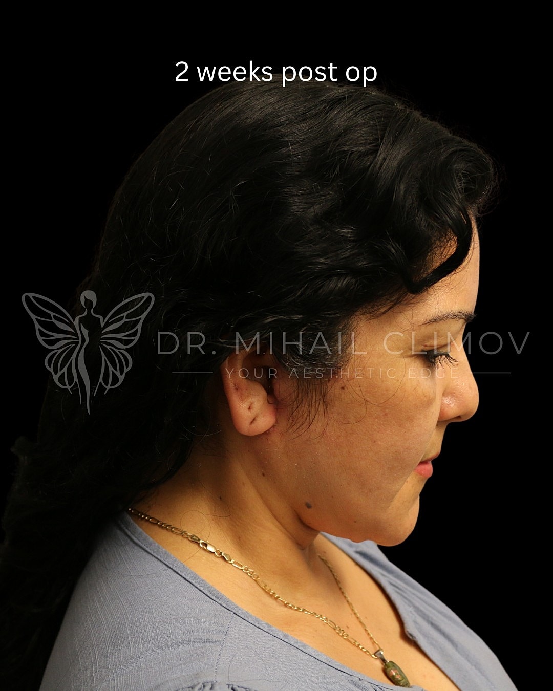 2 weeks post-operative profile view of woman