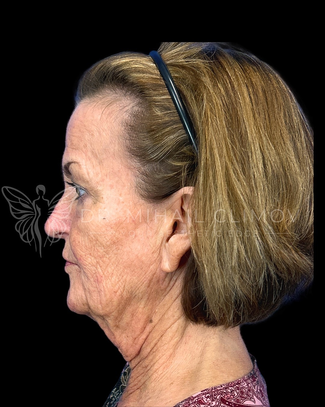 Profile view of woman with medium-length hair.