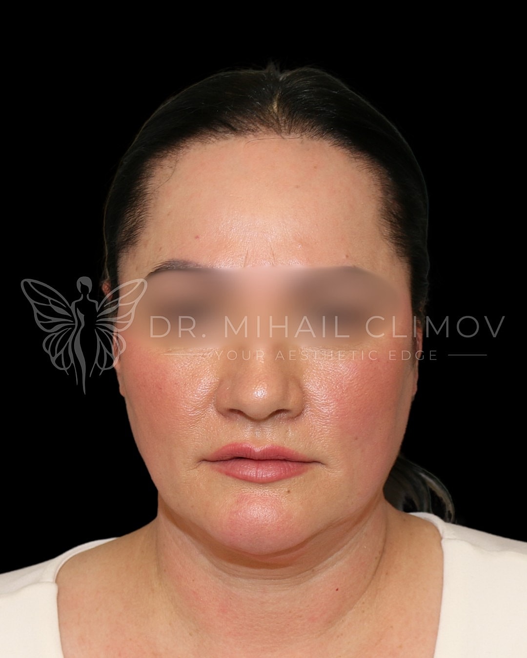 Before an aesthetic treatment consultation.