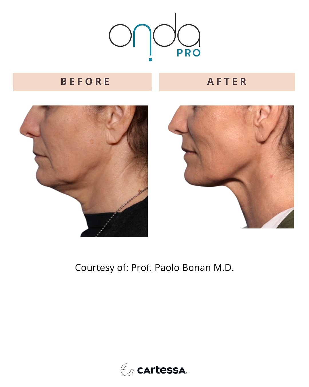Before and after jawline treatment comparison.