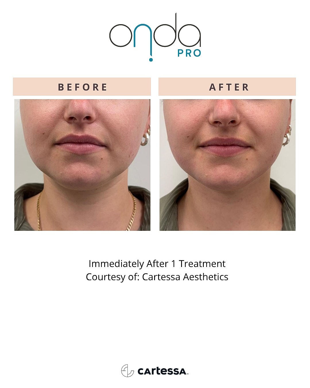 Skin treatment results before and after.