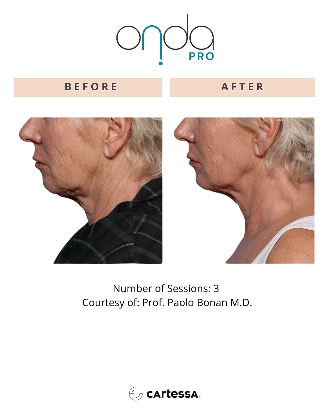 Onda Pro treatment before and after comparison.