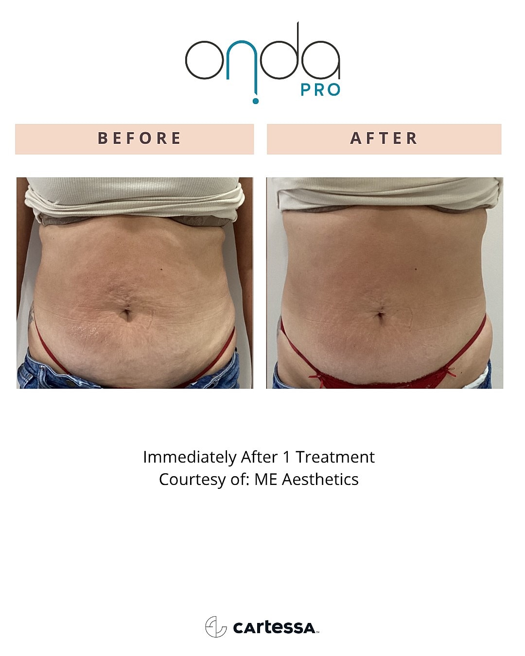 Before and after body treatment comparison.