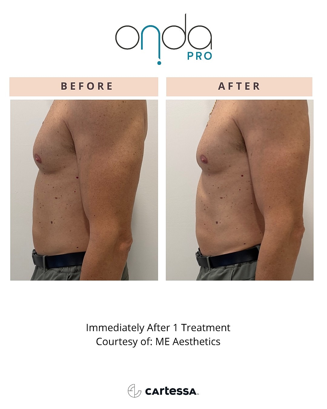 Body contouring treatment before and after results