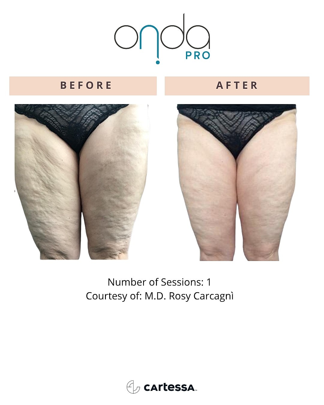 Body contouring treatment results before and after.
